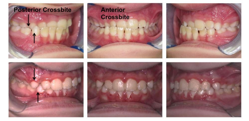 Early Treatment Indiana Pa Cavalancia Orthodontics